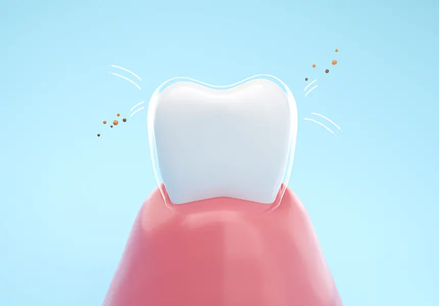 フッ素塗布による歯質強化