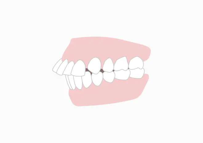 上顎前突(出っ歯)
