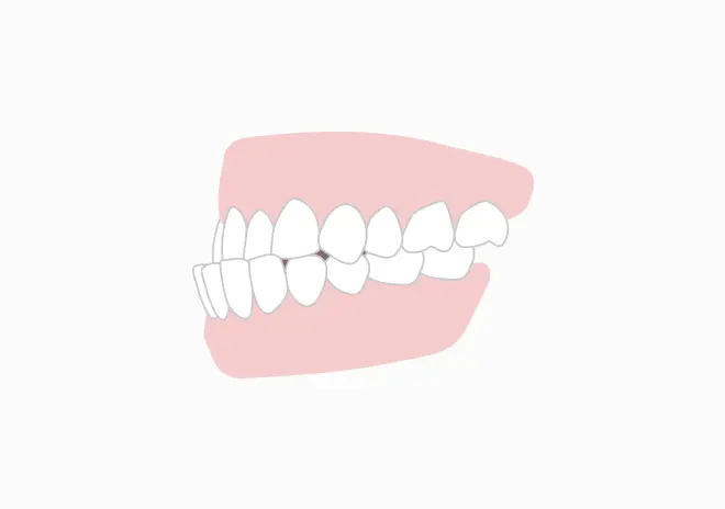 下顎前突<br>(受け口)