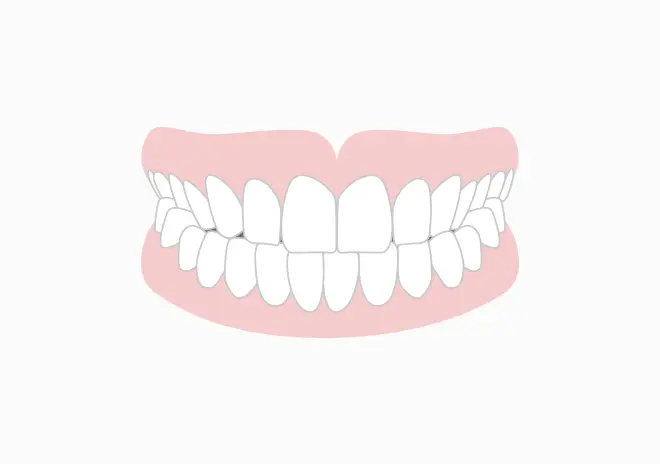 交叉咬合(部分的に噛み合わせが反対)