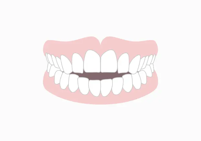 開咬(前歯が噛み合わない)